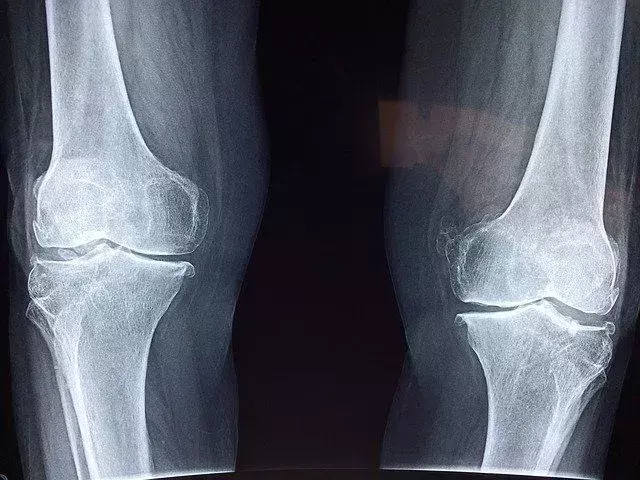 Факти за коляното: функция, наранявания и друга полезна информация